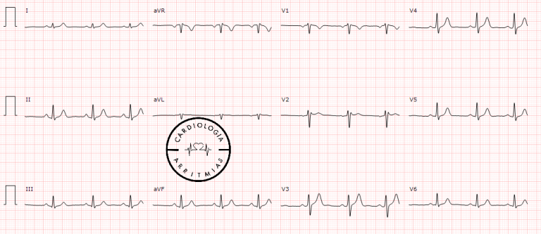 Onda P ECG 2026